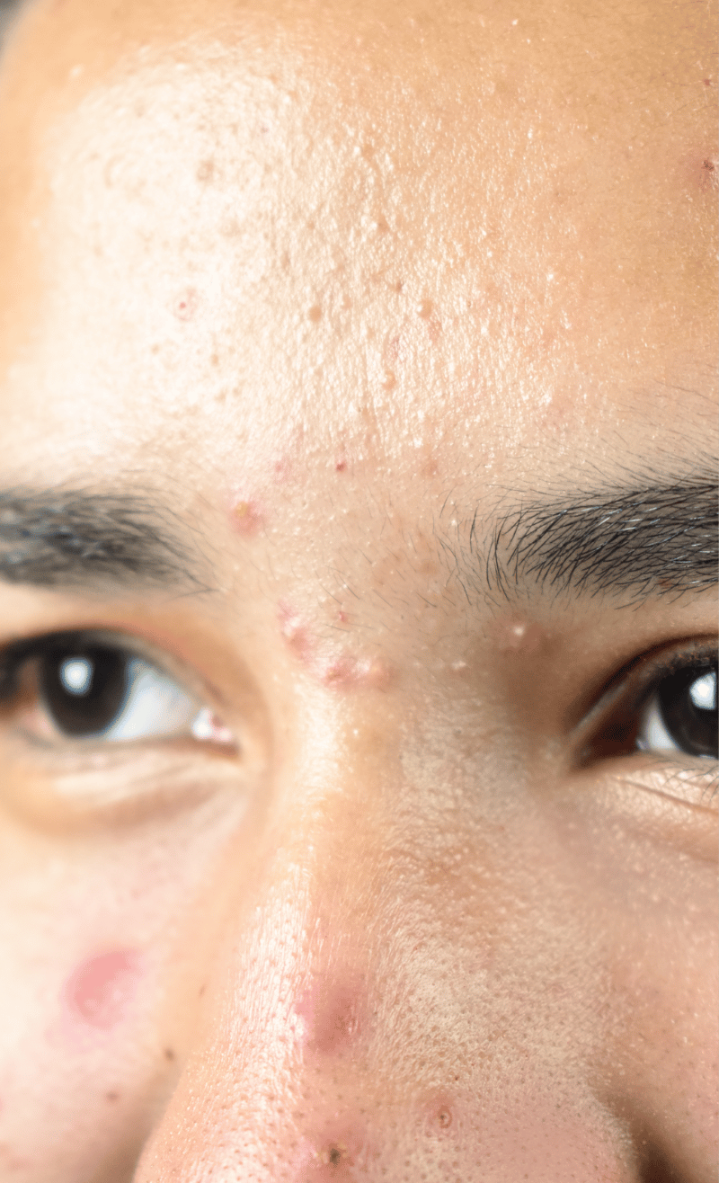 Acne & Congestion