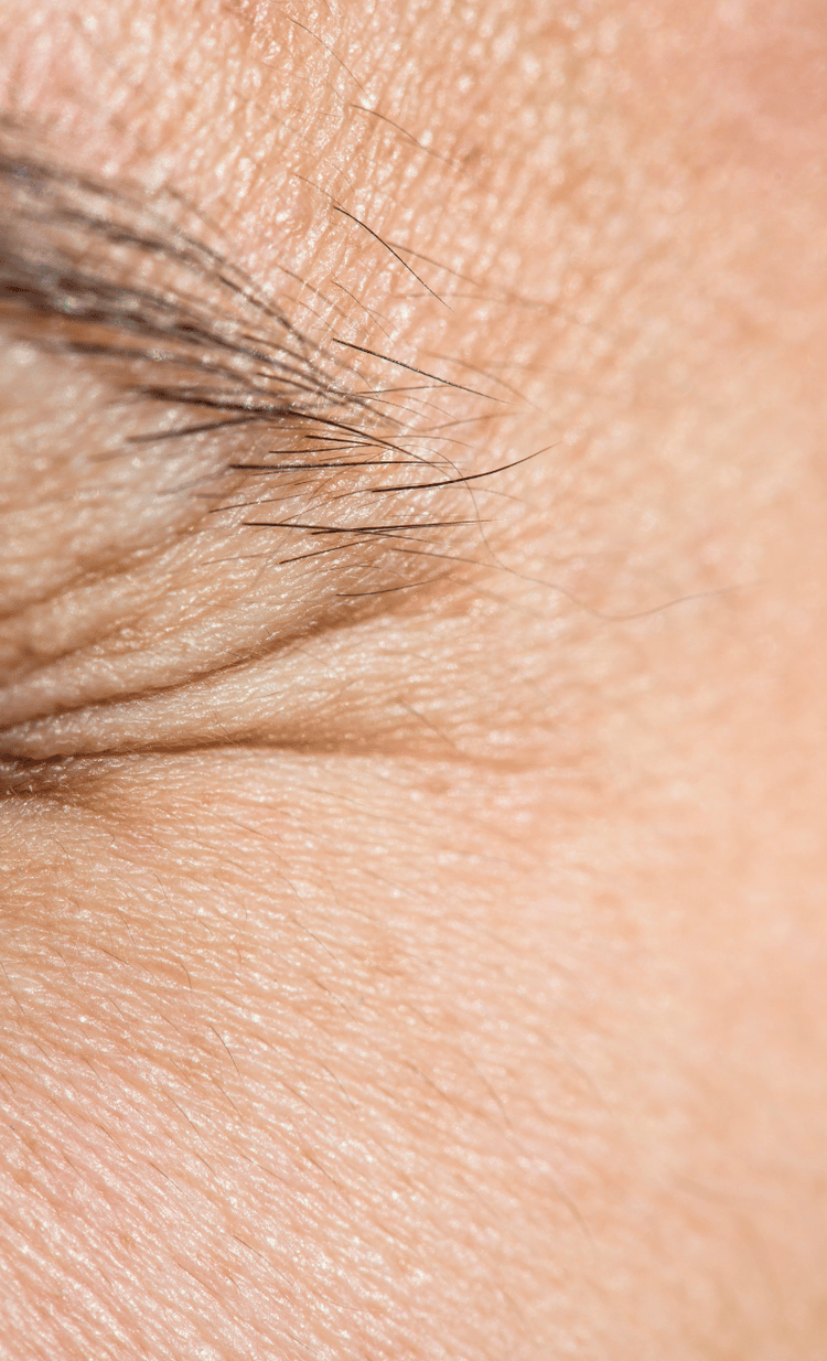Dehydrated Skin