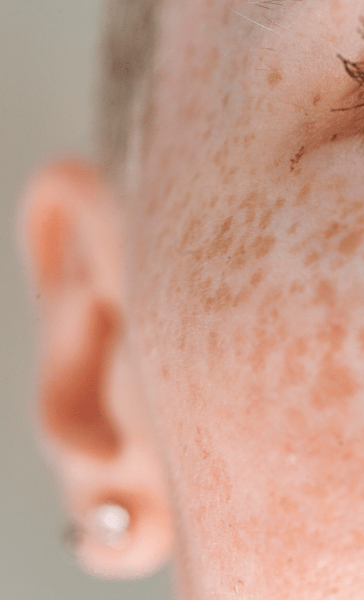 Pigmentation & Sun Damage